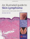 An Illustrated Guide to Skin Lymphoma